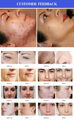 Deep Cleansing Skin Care Facial Cleansing Machine