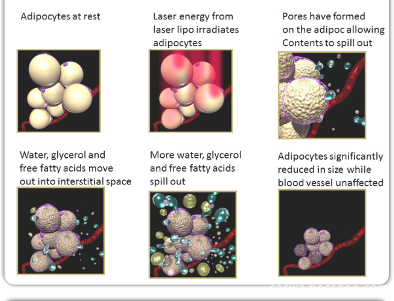 Cryolipolysis Treatment