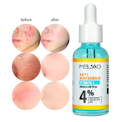 Anti Acne treatment Pimple Remover Serum
