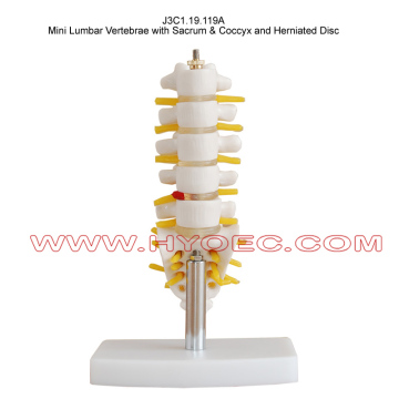 Mini Lumbar Vertebrae with Sacrum & Coccyx and Herniated Disc-J3C1.19.119A
