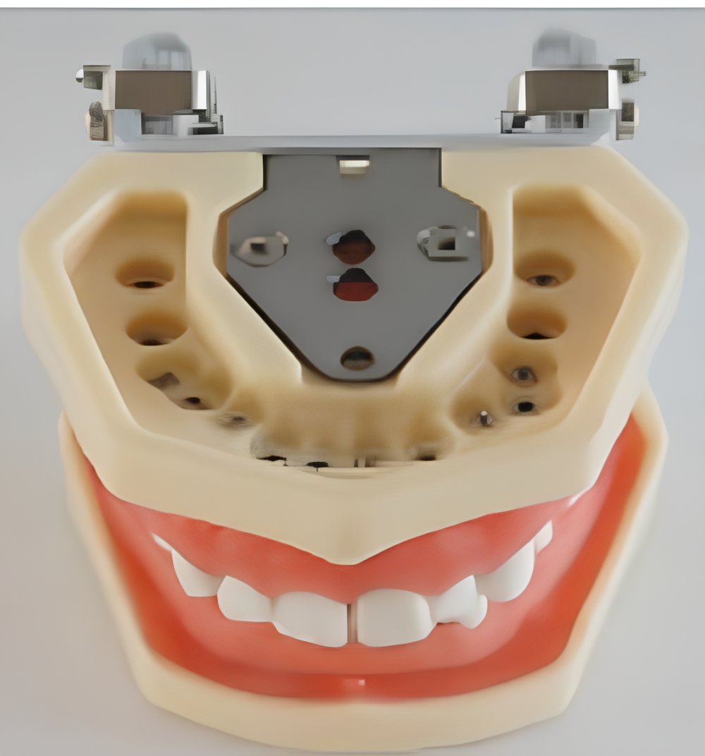 Modelo de dientes estándar con fijación de nueces