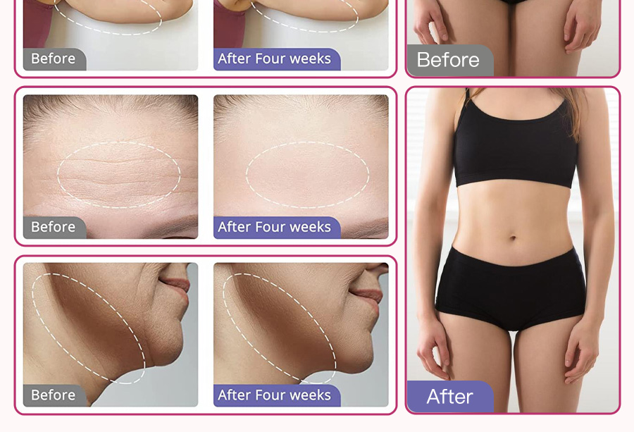 ultrasonic cavitation before after