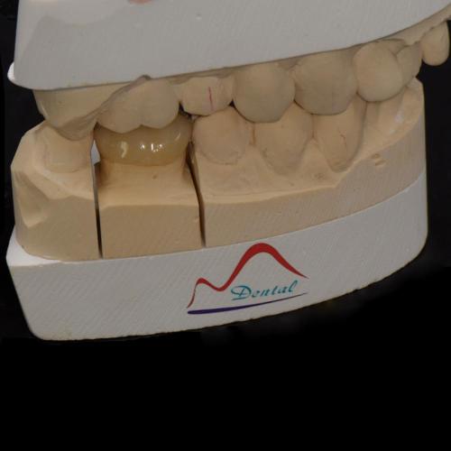 Posterior IPS e.max Press Prosthesis
