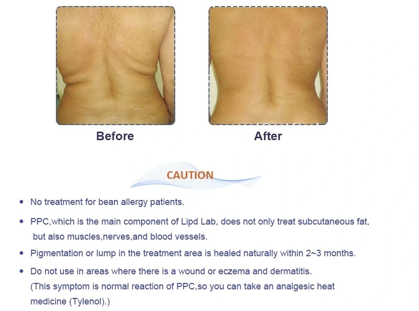 Korea-Lipo-Lab-Lipolab-Phosphatidylcholine-Ppc-Lipolysis-Injection.webp (8)