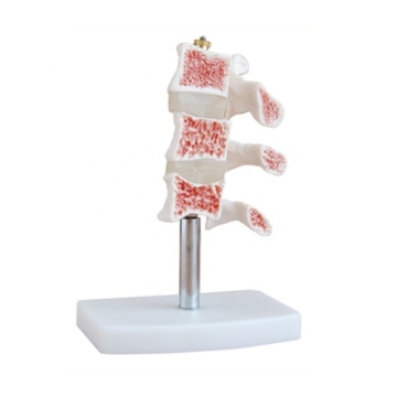 SC-A1022 3 Vertebrae Human Osteoporosis Anatomical Model - Medical Manikin Teaching Instrument