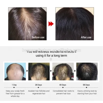YUDA Effective Hair Loss Releasing Hair Growth Spray: Best Reputation