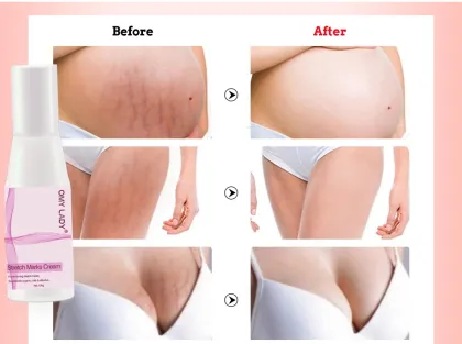 Organic Stretch Mark Removal and Acne Scar Cream