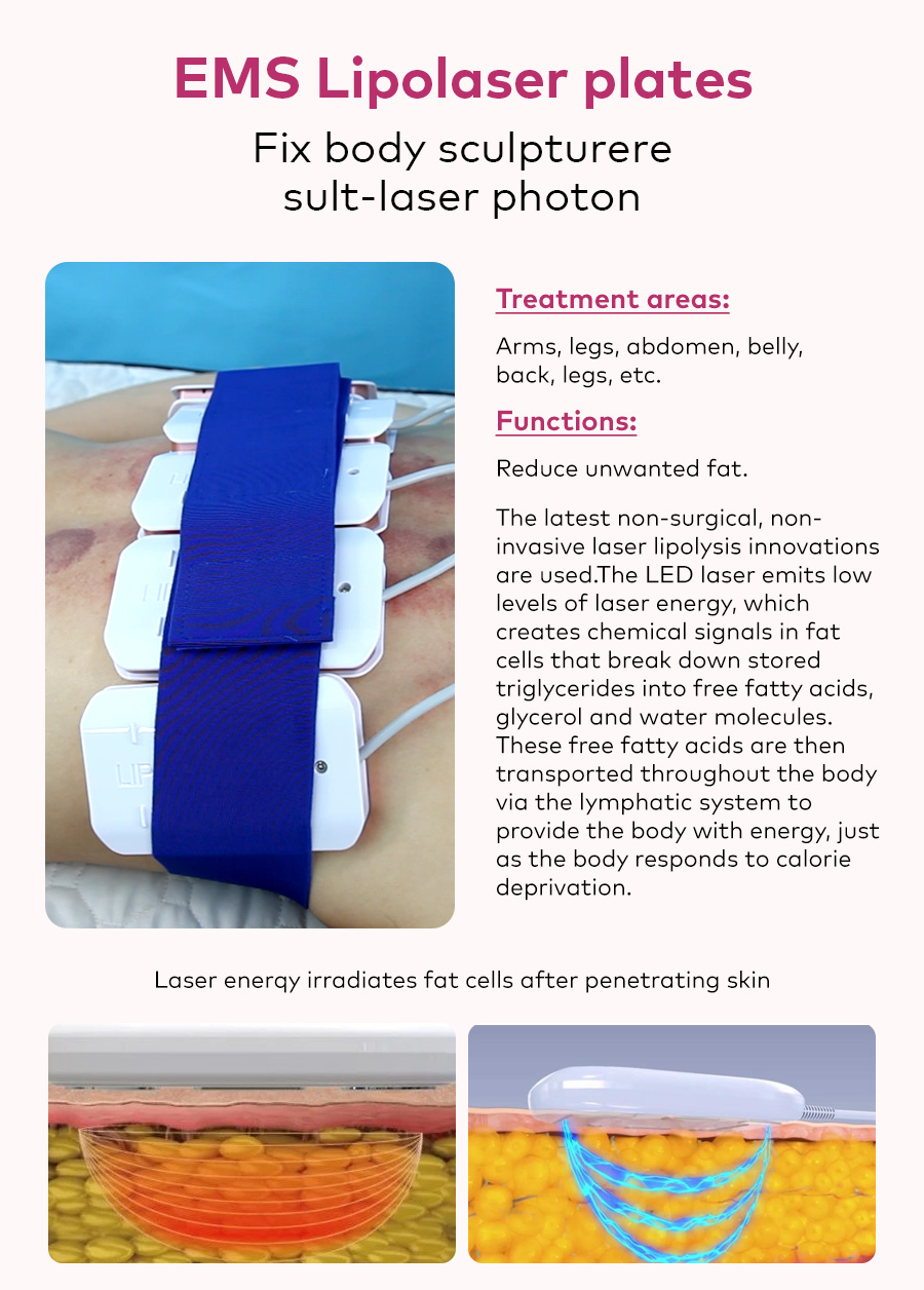 laser lipolysis