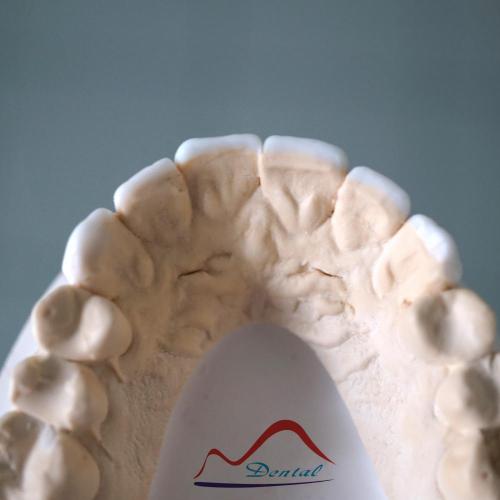 Dental Diagnostic Wax Up
