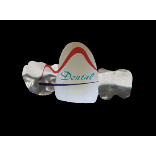 PFM Maryland Bridge, anterior and posterior
