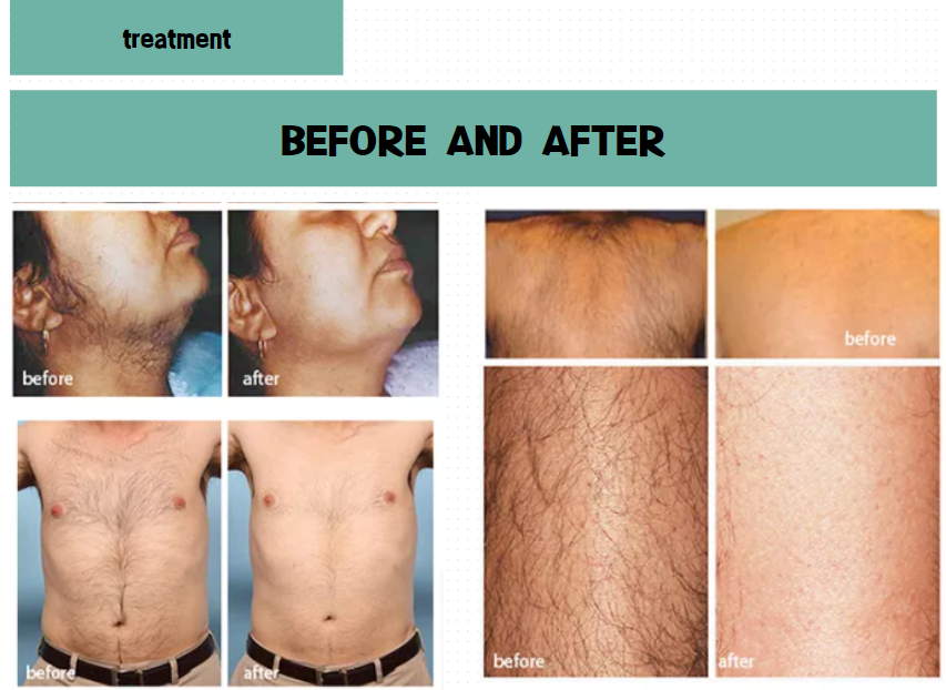 ipl hair removal treatment