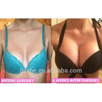 Bust up Breast Enhancer Nature Cross-linked Hyaluronate Acid Fller Singfiller Sub-Q 1.25-2.0mm 20mg/ml Breast enhancement