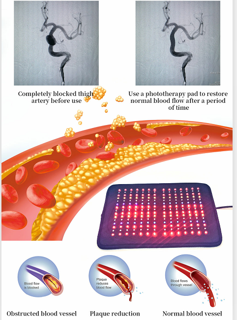 Red Light Therapy Pad Full Body Wearable Led Light Therapy Belt