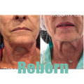 Reborn Medical Stable Hydrogel For Neck Skincare