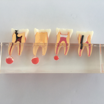 Model Langkah Perawatan Endodontik: Membandingkan Karies Perawatan dan Model Gigi