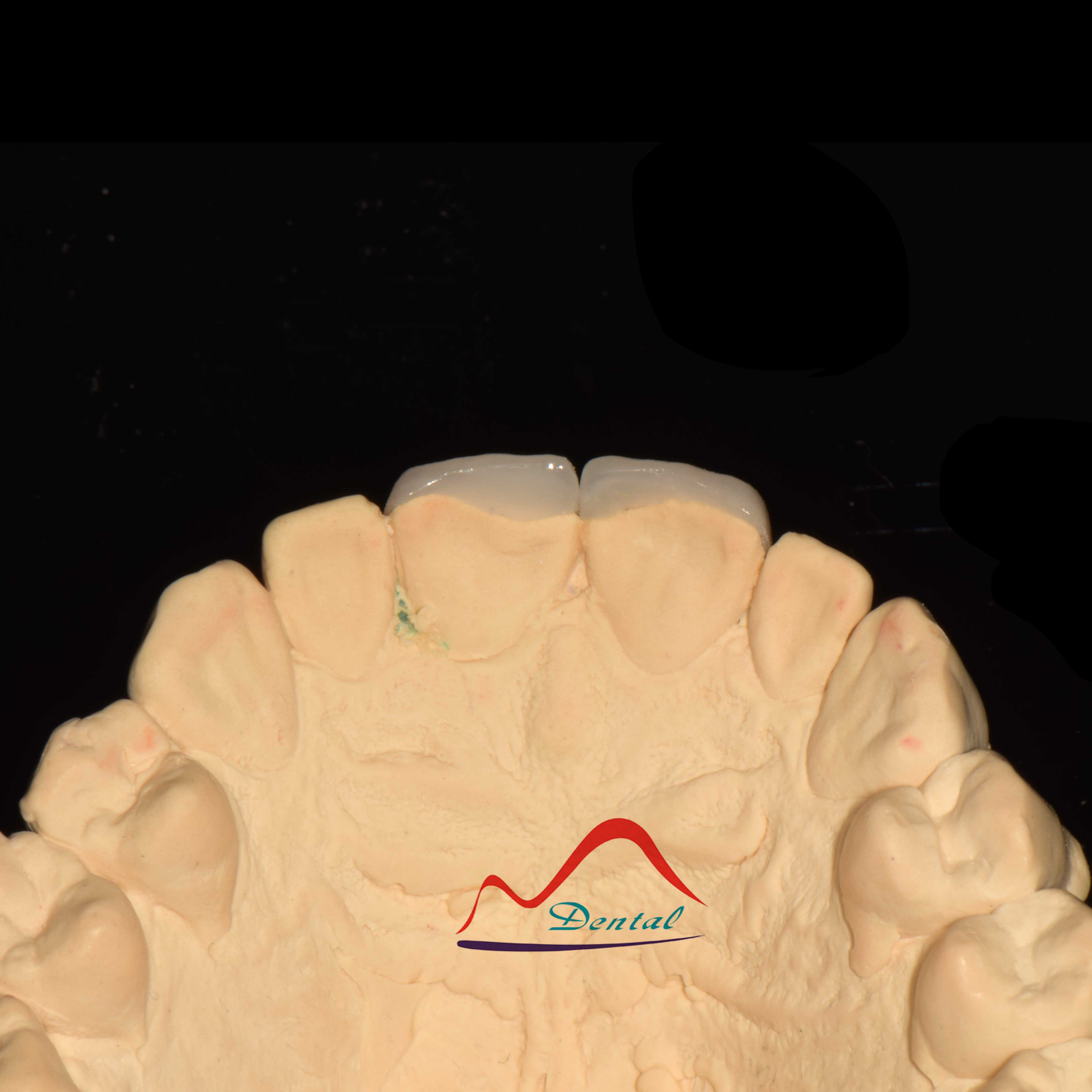 Dental Aesthetic Porcelain Veneers c