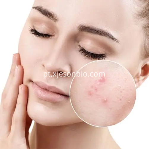 Anti-acne category