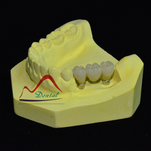 Dental implant PFM bridge_