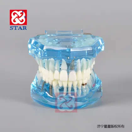 Pathological Dental Implant Restoration Model for Demonstration