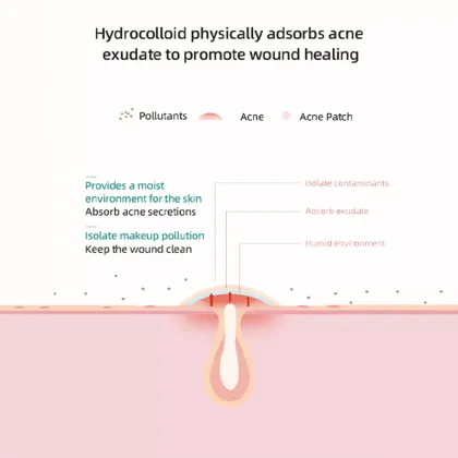 OEM Large Acne Patches - Mild and Non-Irritating Factory Production Line