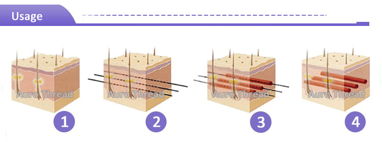 Cog Thread for Face Lift