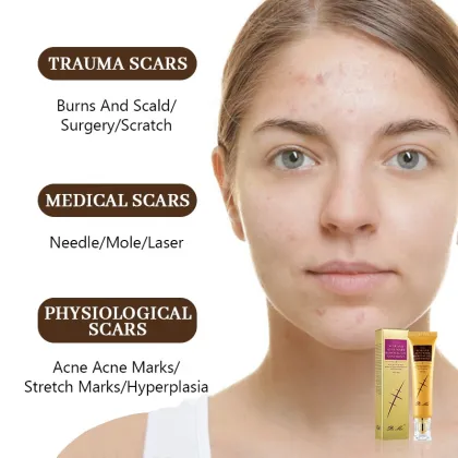 Fast Acne Cream: Anti-Spots, Scar & Stretch Marks Treatment