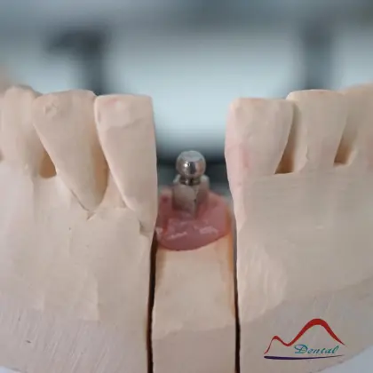 Mandibular Dental Implant Crown