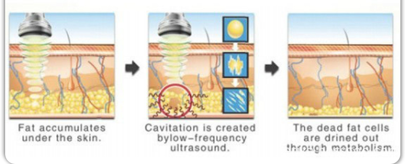 Cristal Cryolipolysis