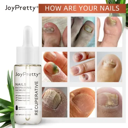 Foot Fungus Treatment: Antifungal Agents & Nail Care Solutions