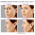 Juvederm Untra 2 3 4 Voluma Volift