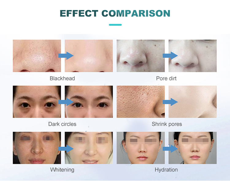 Hydra Beauty Microdermabrasion Face Cleansing Aqua Peel Hydrafacial Machine