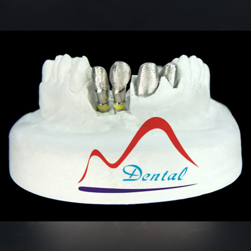 Customized Co-Cr Implant Crown and Bridge