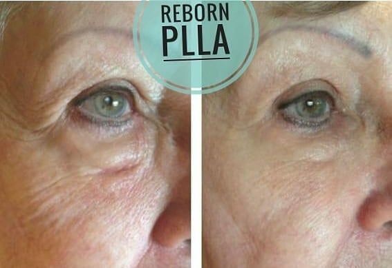 eyes rejuvenation treatment