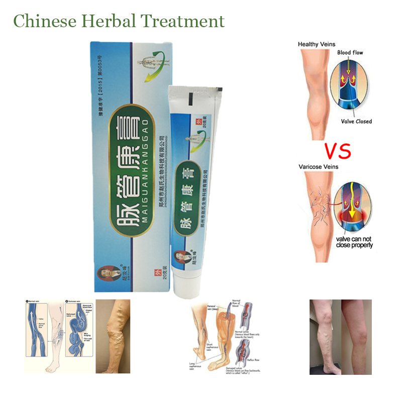 10Pcs Varicose Veins ointment vasculitis treatment Phlebitis Angiitis inflammation blood vessel Rotten legs Varicose Veins Cream