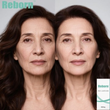 Non-surgical Face Lifting With Reborn Poly-L-lactic Acid PLLA Injection Fillers