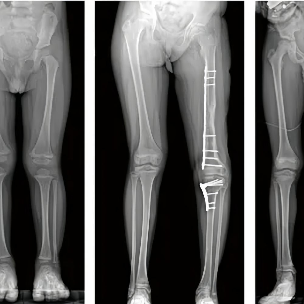 Motorized U Arm X-ray Frame