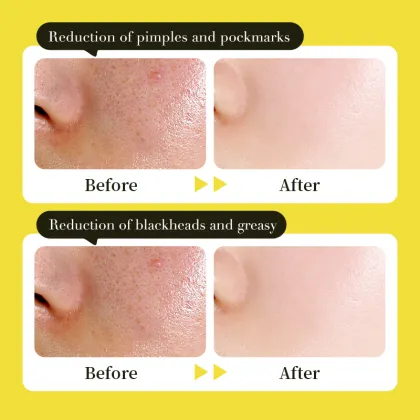 Honey Poeming Private Label Acne Treatment Mask