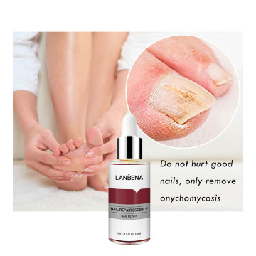 7-tägige Behandlung natürlicher Nagelpilz: Verhinderung und Reparatur von Antimykotika-Nagelserum zur Stärkung der beschädigten Nägel