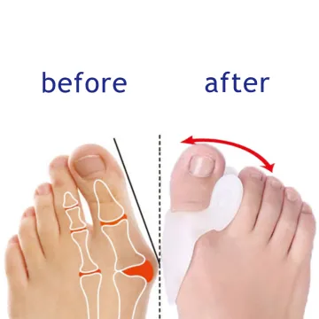 1Pair silicone gel thumb set big toe separator protector relieve foot pain foot hallux valgus correction pad toe braces