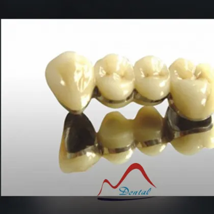 Strong dental Precious PFM