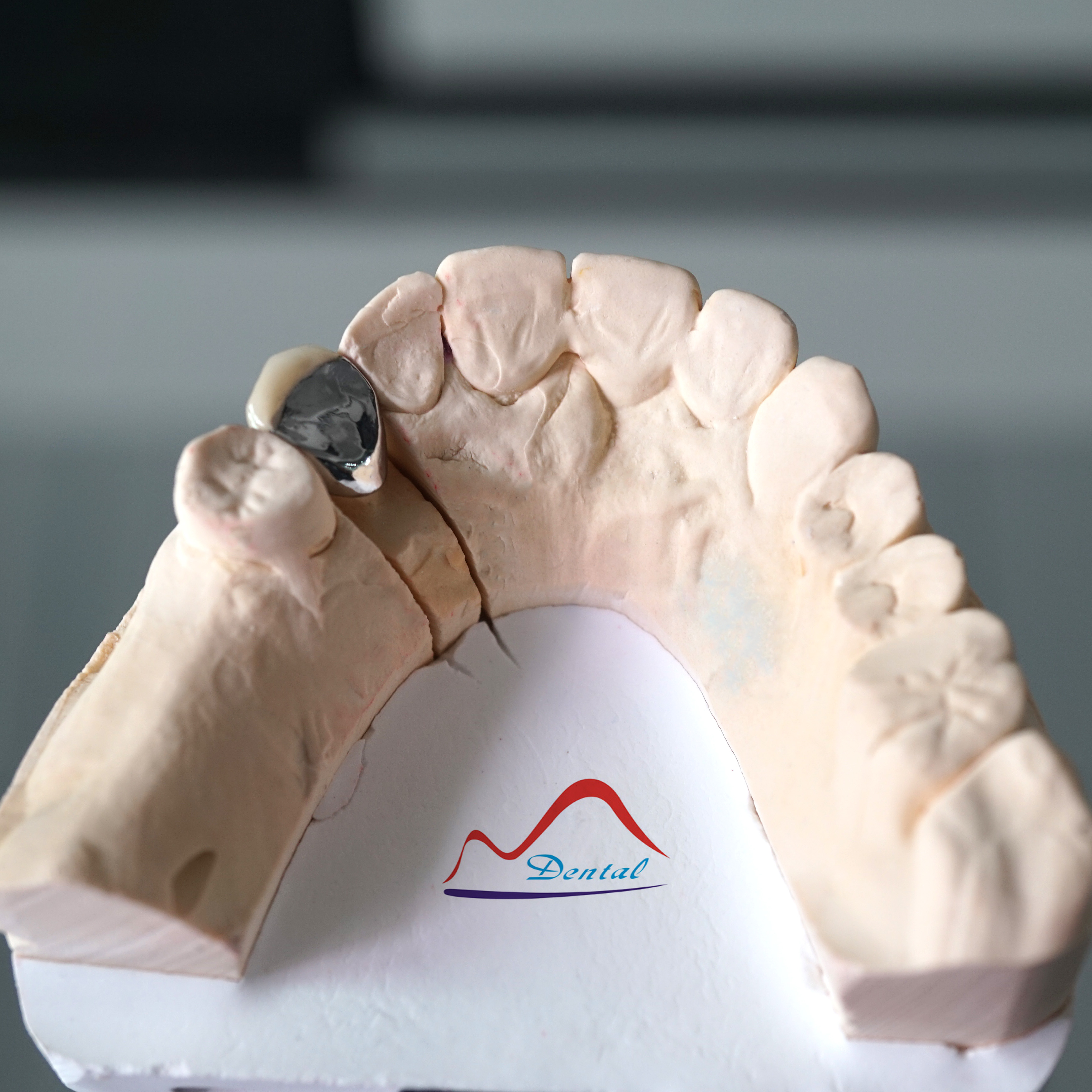 Porcelain Metal Crown (4)