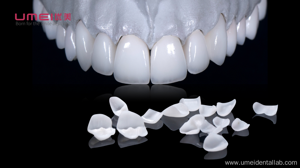 Hollywood White Veneers