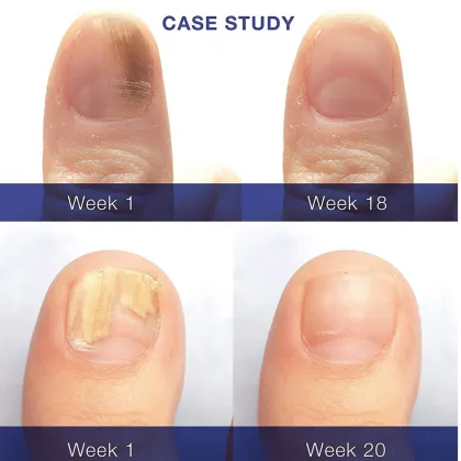YURHERSU Foot Care Nail Repair Essence