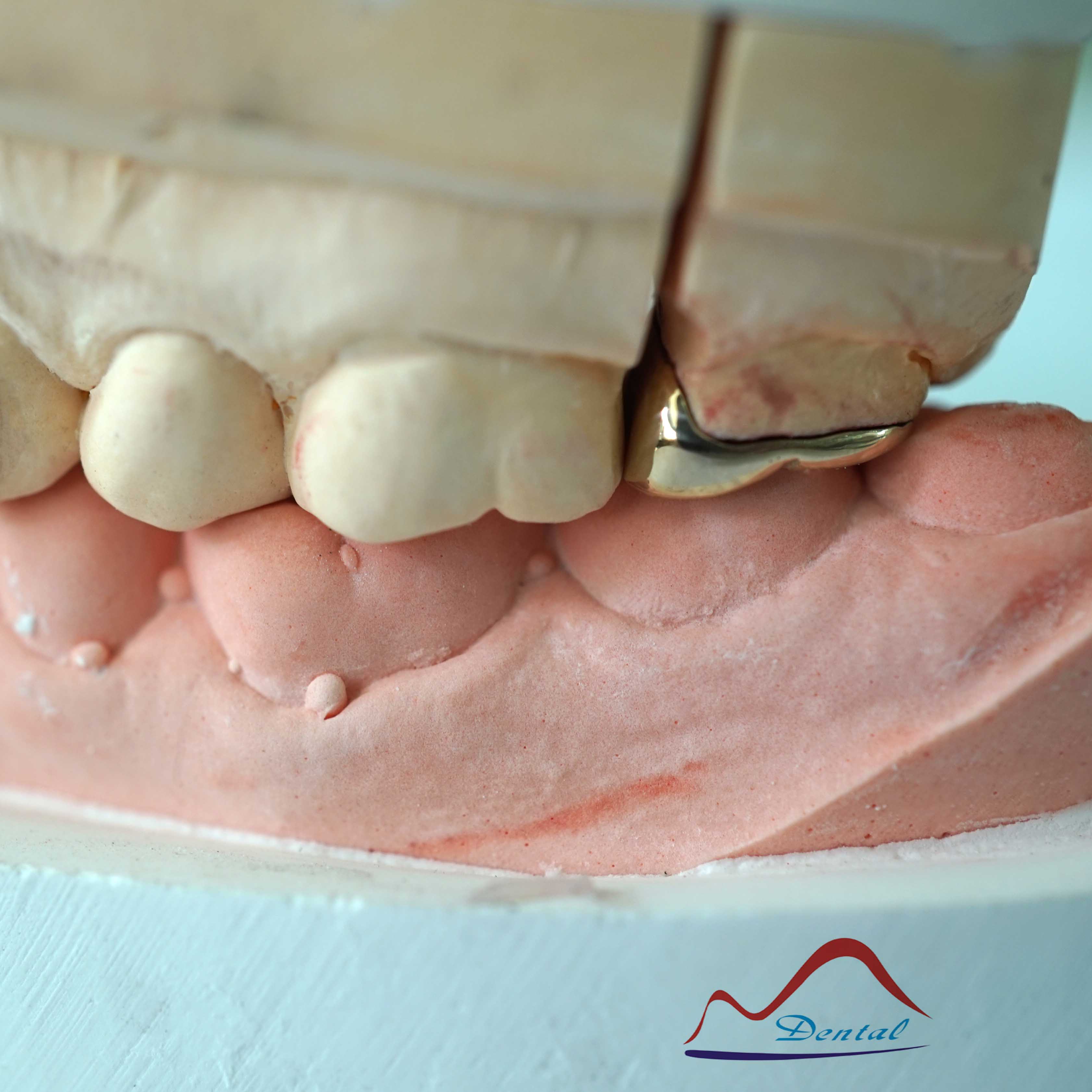 DENTAL Molar Gold Onlay d