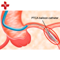 قسطرة البالون PTCA داخل الأوعية