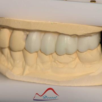 Posterior Aestherics Diagnostic Wax Up