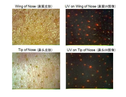 Portable Skin Analysis Device For Skin Uv / Base Layer Detection
