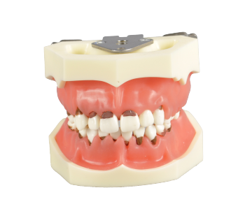 Penyakit periodontal edentulous: Studi dan praktik model gigi
