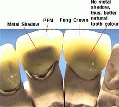 Corrosion Resistant  Texture Porcelain Fused To Metal Teeth For Bio Ceramic Dental