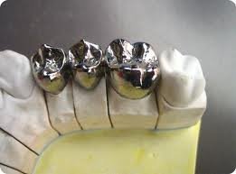 High Strength Metal Dental Crowns With White Gold, Yellow Gold For Esthetical Dental Units